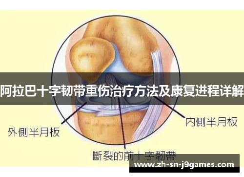阿拉巴十字韧带重伤治疗方法及康复进程详解 阿拉巴十字韧带重伤治疗方法及康复进程详解